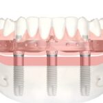 fogászat fogimplantátum fogpótlás