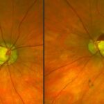 zöldhályog korai kezelésével megelőzhető a teljes vakság