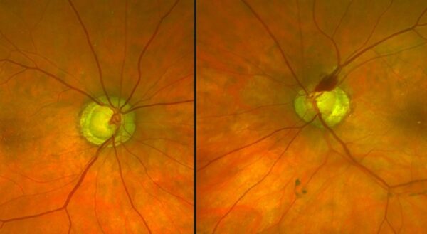 zöldhályog korai kezelésével megelőzhető a teljes vakság