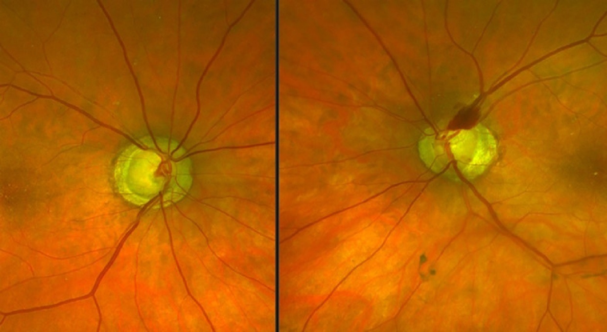 zöldhályog korai kezelésével megelőzhető a teljes vakság
