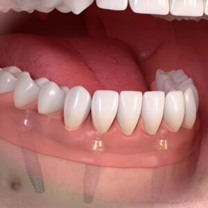 fogbeültetés implantátum